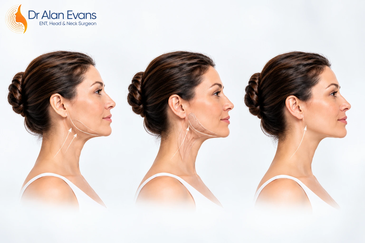 Neck Lift Cost
