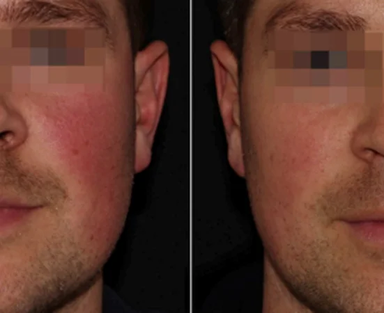 Pigment laser therapy for sun spots and uneven pigmentation