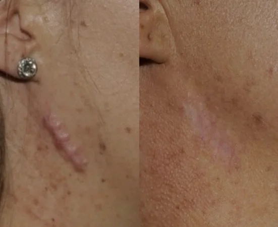 Laser scar treatment for smoother facial skin