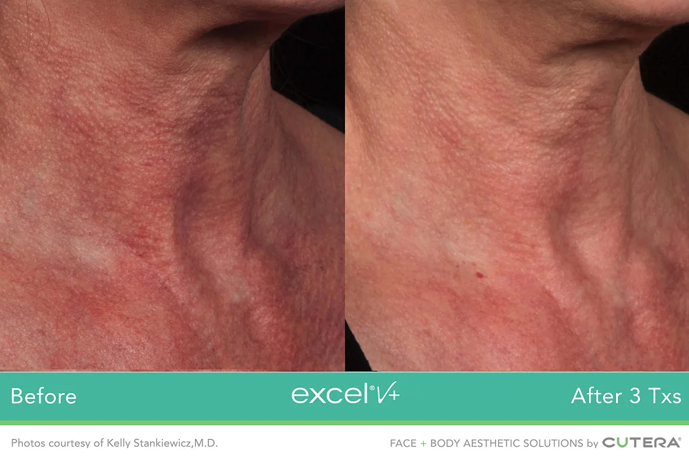 Vascular and pigment laser treatment for clearer-looking skin