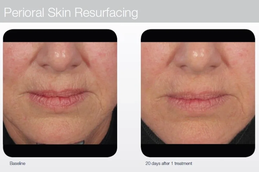 Laser facial treatment for scars and skin rejuvenation