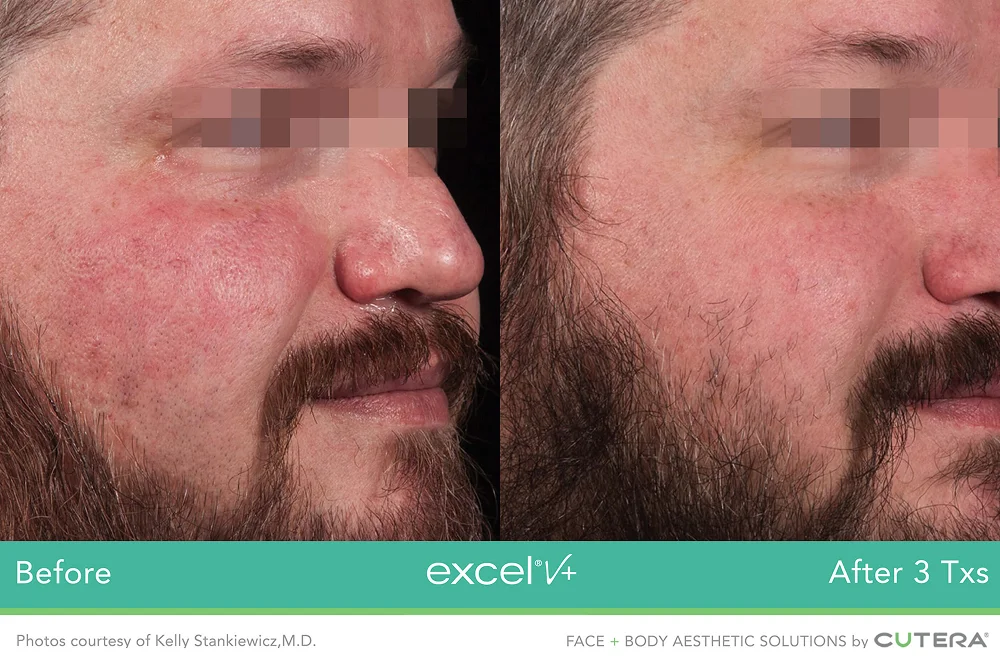 Pigment laser treatment for uneven skin tone and pigmentation