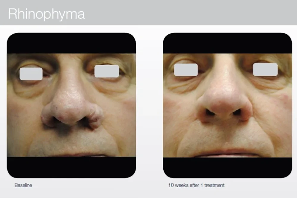 Facial laser resurfacing for improved skin texture