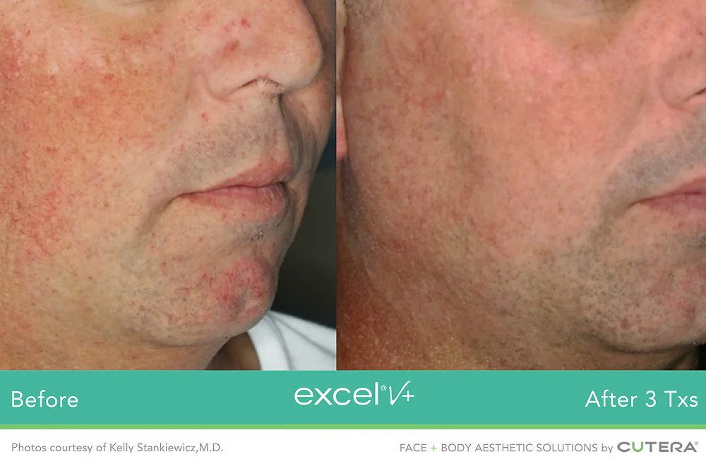 Vascular laser treatment for visible facial blood vessels