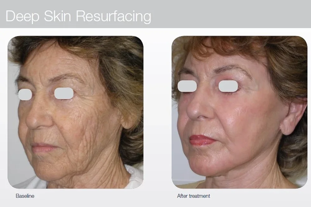 Facial laser resurfacing treatment for smoother skin