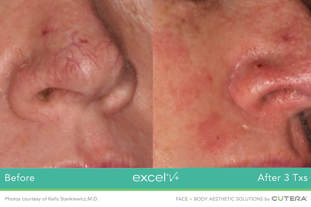 Vascular and pigment laser treatment for skin concerns