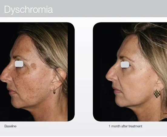 Laser skin treatment targeting pigmentation