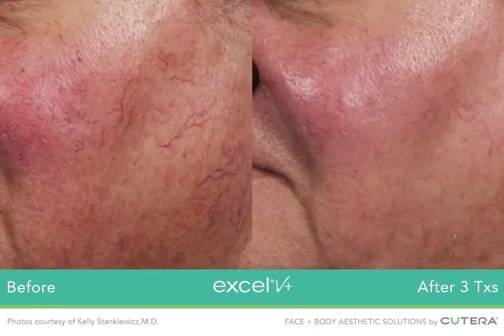 CO2 ablative laser treatment for smoother skin