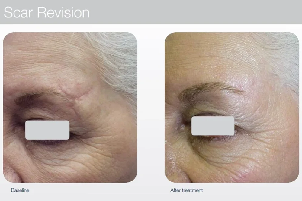 CO2 laser resurfacing for acne scars and skin texture